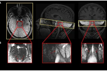 Caractérisation structurelle et fonctionnelle du locus coeruleus chez les jeunes et les personnes d'âge moyen avancé