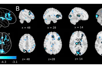  Les désactivations du cerveau entier précèdent les rapports de suppression de l'esprit non induits