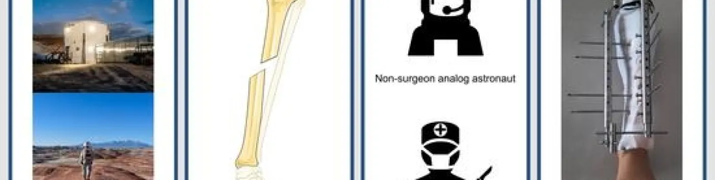 Un fixateur externe facile à utiliser dans tous les environnements hostiles, de l'espace à la médecine de guerre : est-ce que tout le monde pourra l'utiliser ?