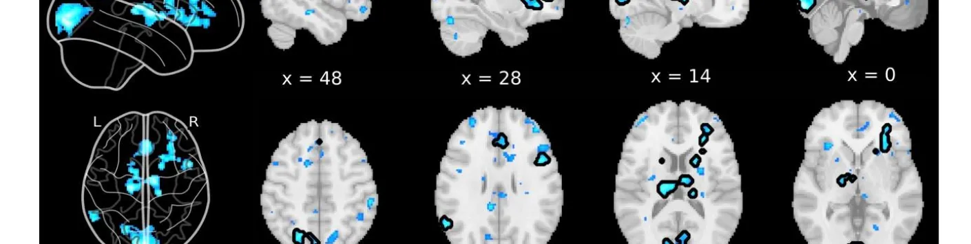  Les désactivations du cerveau entier précèdent les rapports de suppression de l'esprit non induits