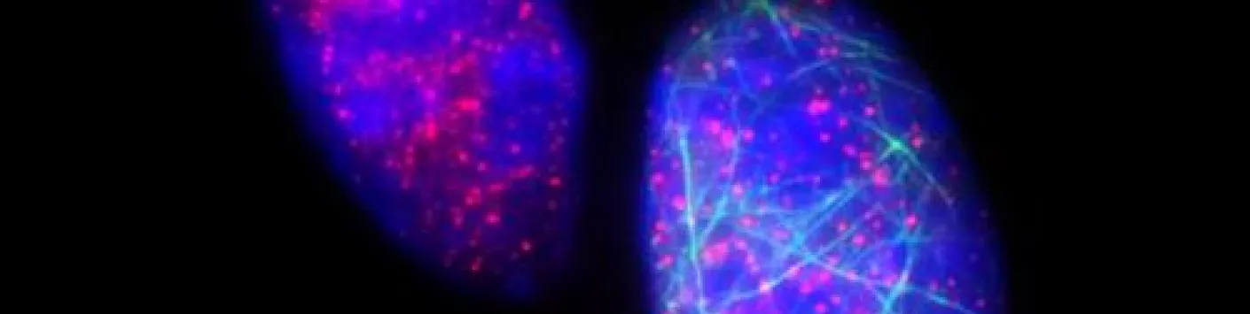 Cancer: Découverte d’une protéine contrôlant la résistance à la chimiothérapie